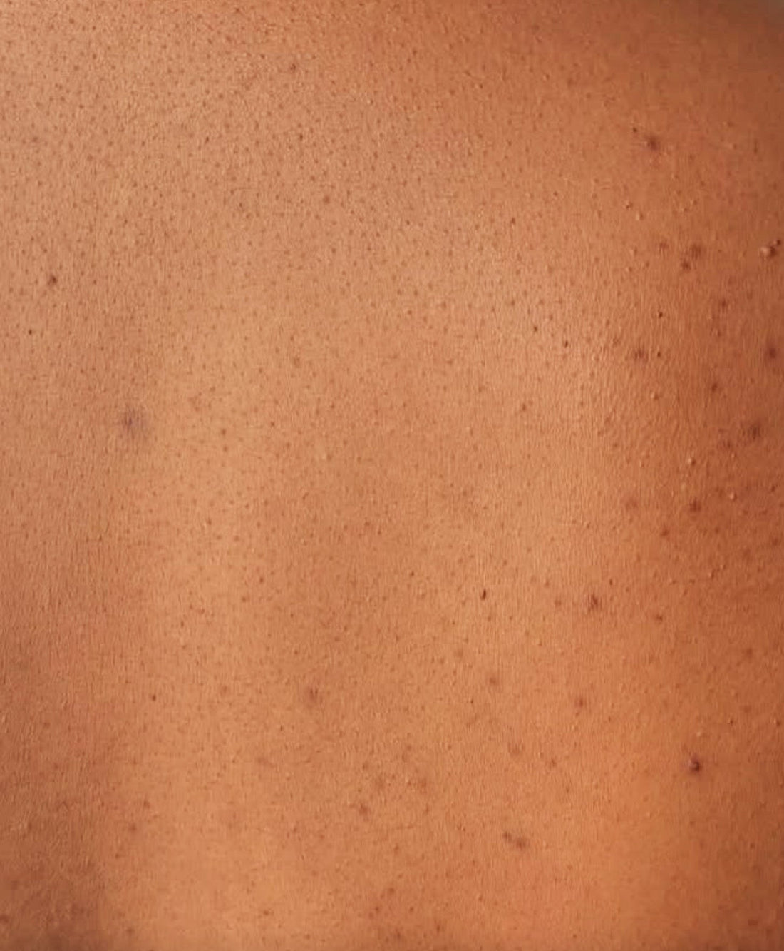 Keratosis Pilaris - The Bumpy Arm Skin Condition You Probably Have and Definitely Don't Need to Worry About