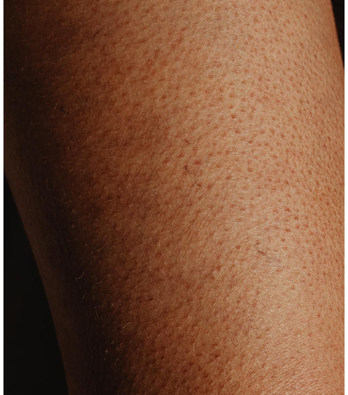 Let’s Talk About ‘Chicken Skin, What It Is & How to Smooth It ...