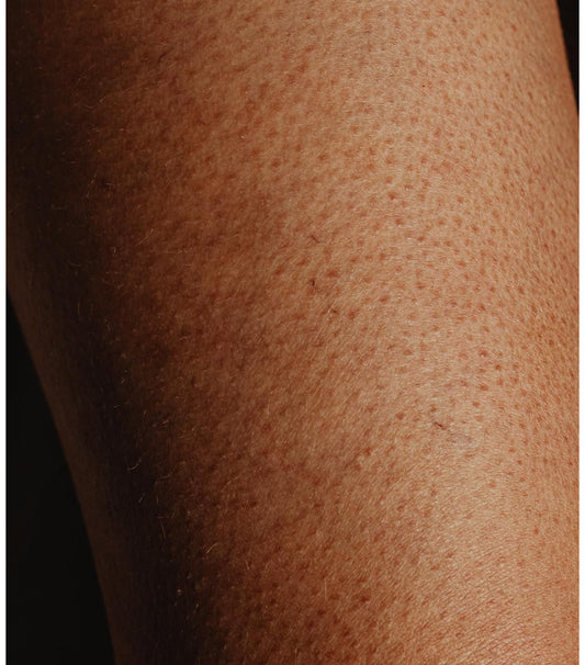 Let’s Talk About ‘Chicken Skin, What It Is & How to Smooth It
