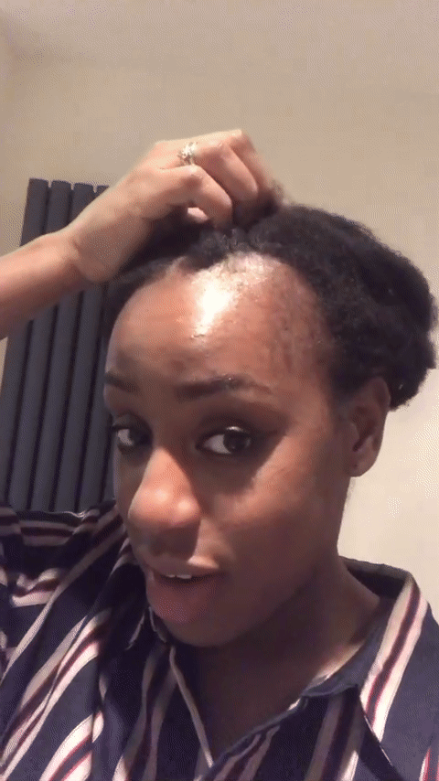 What Is Postpartum Hair Loss?